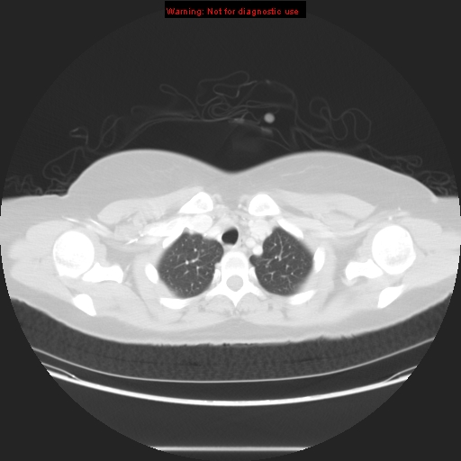 Carotid body tumor with lung metastases (Radiopaedia 9301-48390 Axial lung window 16).jpg
