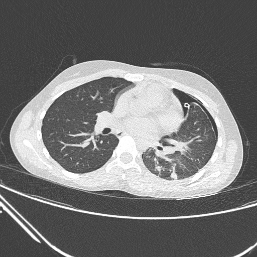 Catamenial pneumothorax (Radiopaedia 27946-28197 lung window 83).jpg
