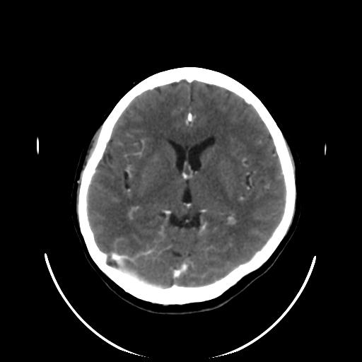 File:Cavernoma with developmental venous anomaly (Radiopaedia 22470-22506 C+ arterial phase 19).jpg