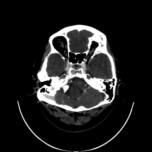 Cavernoma with developmental venous anomaly (Radiopaedia 22470-22506 C 22).jpg