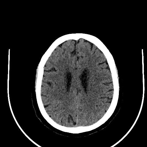 Cavernous hemangioma of the cerebellar falx (Radiopaedia 73025-83723 Axial non-contrast 94).jpg