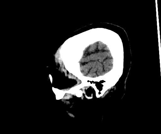 Cavernous hemangioma of the cerebellar falx (Radiopaedia 73025-83723 B 295).jpg