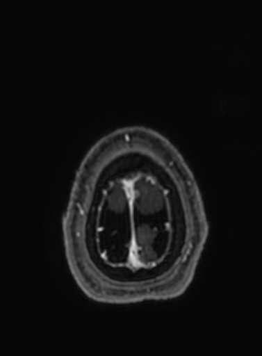 Cavernous hemangioma of the cerebellar falx (Radiopaedia 73025-83724 Axial T1 C+ 25).jpg