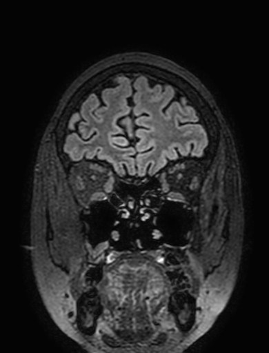 Cavernous hemangioma of the cerebellar falx (Radiopaedia 73025-83724 Coronal FLAIR 61).jpg