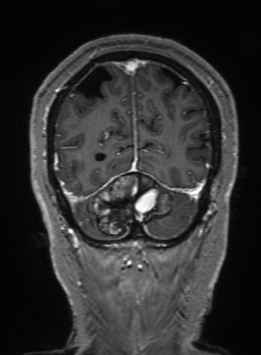 Cavernous hemangioma of the cerebellar falx (Radiopaedia 73025-83724 Coronal T1 C+ 316).jpg