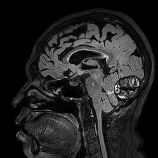Cavernous hemangioma of the cerebellar falx (Radiopaedia 73025-83724 Sagittal FLAIR 113).jpg