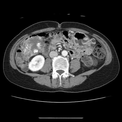 File:Cavernous hepatic hemangioma (Radiopaedia 75441-86667 B 63).jpg