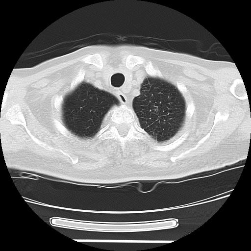Cavitating pulmonary metastases (Radiopaedia 89545-106544 Axial lung window 7).jpg
