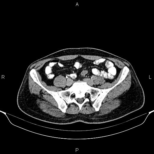 Cecal adenocarcinoma (Radiopaedia 85324-100916 Axial C+ delayed 72).jpg
