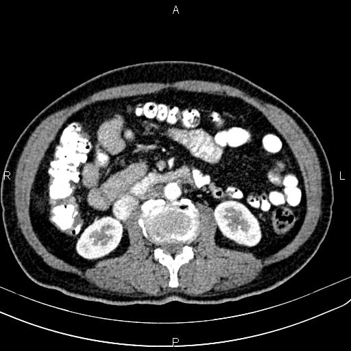 File:Cecal cancer with appendiceal mucocele (Radiopaedia 91080-108651 A 89).jpg