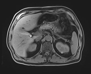 Cecal mass causing appendicitis (Radiopaedia 59207-66532 Axial T1 43).jpg