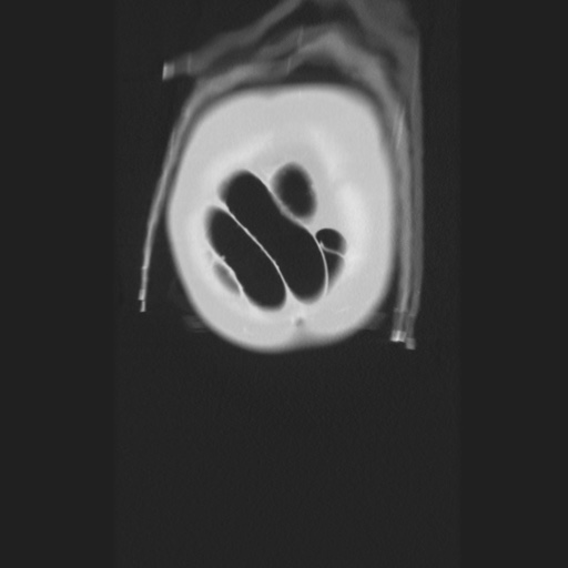 Cecal volvulus (Radiopaedia 75378-86620 Coronal lung window 14).jpg