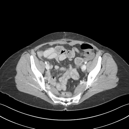 File:Cecum hernia through the foramen of Winslow (Radiopaedia 46634-51112 A 59).png