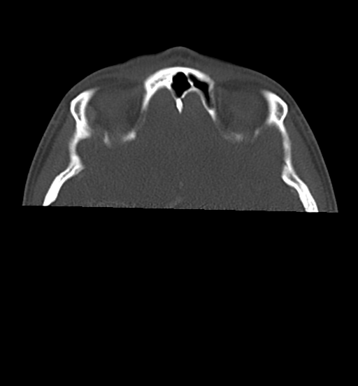 Cemento-ossifying fibroma (Radiopaedia 46243-50643 Axial bone window 13).png