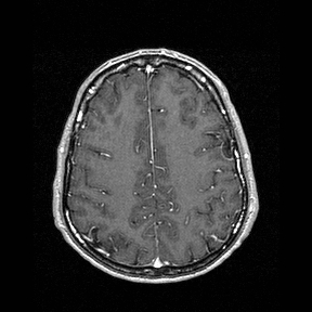 Central-variant posterior reversible encephalopathy syndrome (PRES) (Radiopaedia 43880-47358 Axial T1 C+ 122).jpg