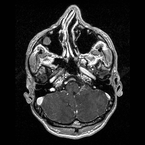 Central-variant posterior reversible encephalopathy syndrome (PRES) (Radiopaedia 43880-47358 Axial T1 C+ 24).jpg