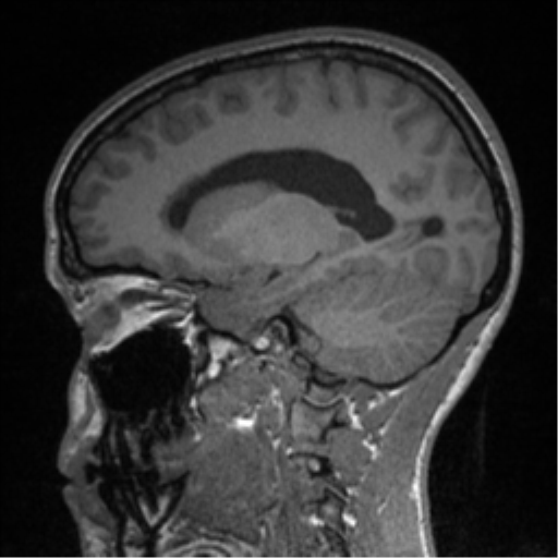 Central neurocytoma (Radiopaedia 37664-39557 Sagittal T1 61).png