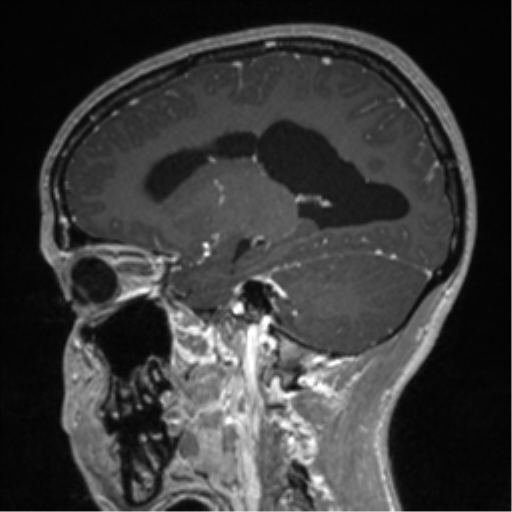 Central neurocytoma (Radiopaedia 37664-39557 Sagittal T1 C+ 35).png