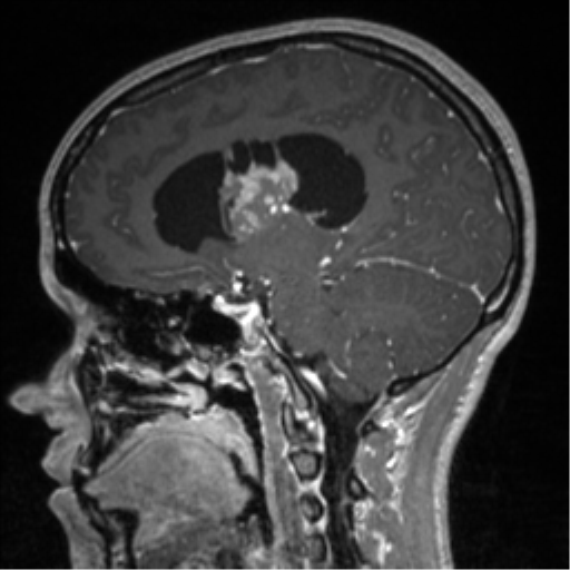 File:Central neurocytoma (Radiopaedia 37664-39557 Sagittal T1 C+ 43).png