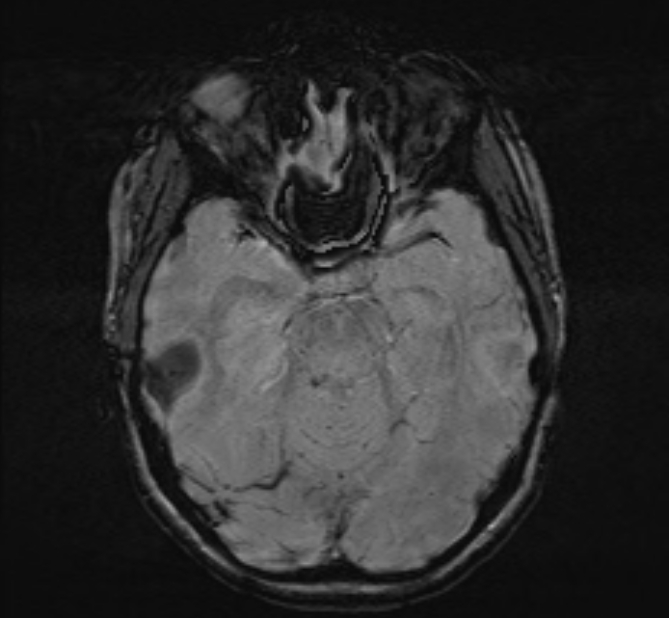 Central neurocytoma (Radiopaedia 70263-80336 Axial SWI 20).jpg