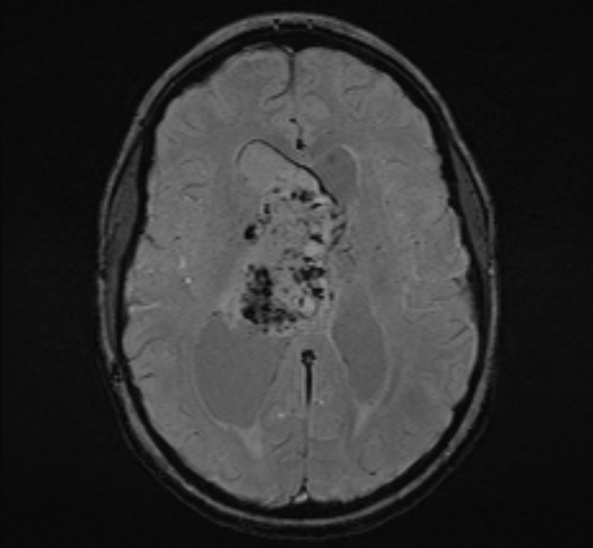 Central neurocytoma (Radiopaedia 70263-80336 Axial SWI 33).jpg