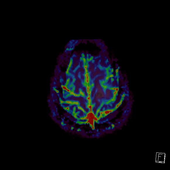 Central neurocytoma (Radiopaedia 84497-99872 Axial Perfusion 32).jpg