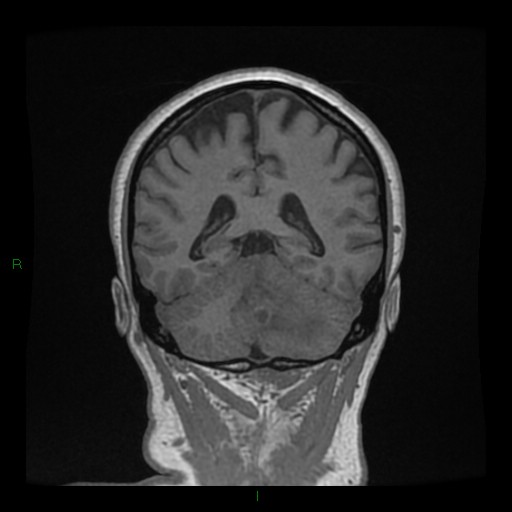 Cerebellar abscess (Radiopaedia 78135-90678 Coronal T1 C+ 111).jpg
