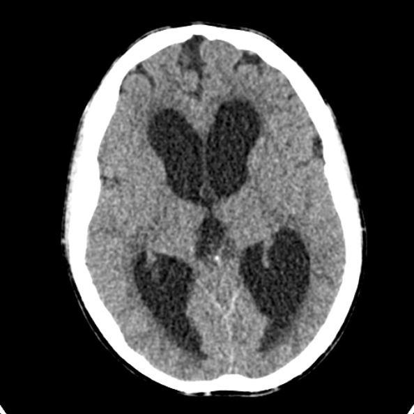 Cerebellar abscess secondary to mastoiditis (Radiopaedia 26284-26412 Axial non-contrast 79).jpg