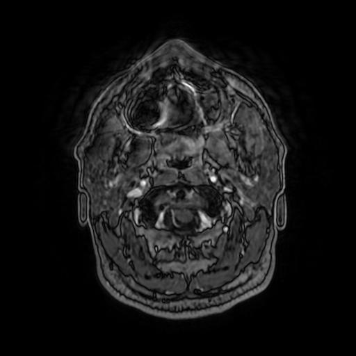 Cerebellar hemangioblastoma (Radiopaedia 88055-104622 Axial T1 C+ 21).jpg