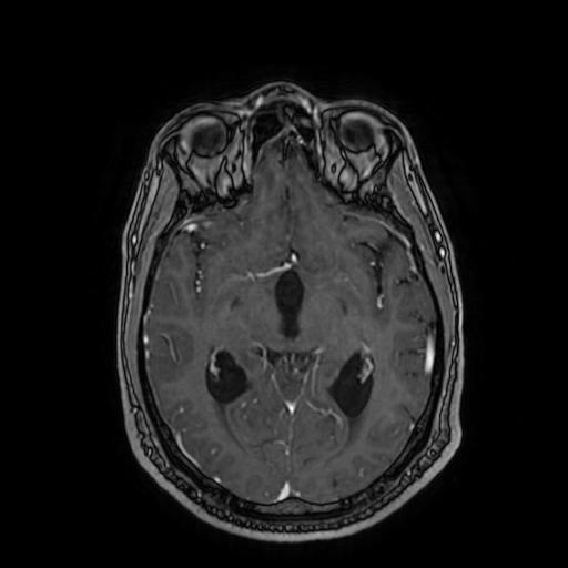 Cerebellar hemangioblastoma (Radiopaedia 88055-104622 Axial T1 C+ 88).jpg