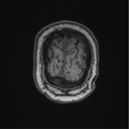 Cerebellar hemangioblastomas and pituitary adenoma (Radiopaedia 85490-101176 Coronal T1 13).png