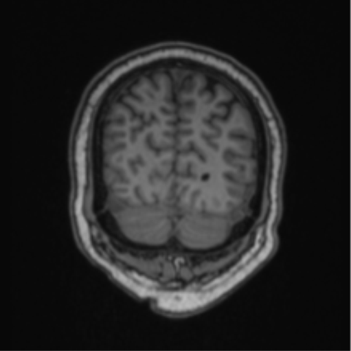 File:Cerebellar hemangioblastomas and pituitary adenoma (Radiopaedia 85490-101176 Coronal T1 21).png