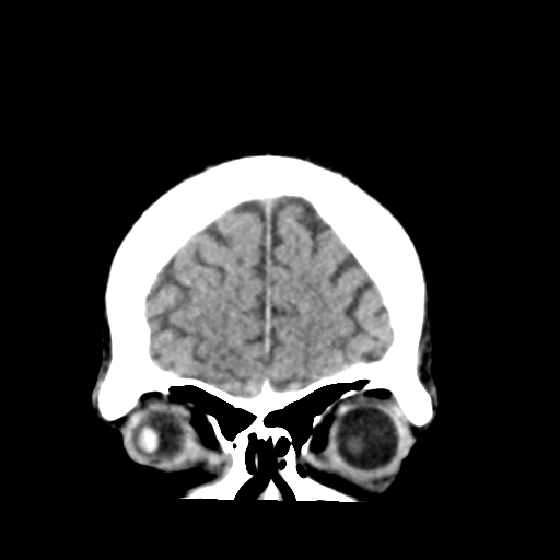 File:Cerebellar hemorrhage (Radiopaedia 37000-38669 Coronal non-contrast 7).png