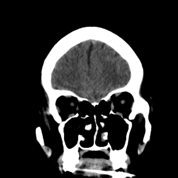 Cerebellar hemorrhage causing obstructive hydrocephalus (Radiopaedia 33989-35207 Coronal non-contrast 14).jpg