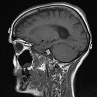 File:Cerebellar metastases (Radiopaedia 24038-24249 Sagittal T1 5).jpg