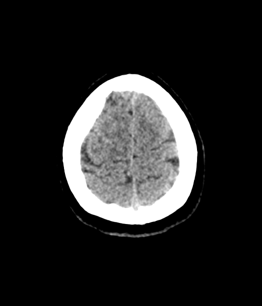 Cerebellar metastases - colorectal adenocarcinoma (Radiopaedia 40947-43652 Axial non-contrast 60).png