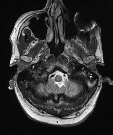 File:Cerebellar metastasis (Radiopaedia 33616-34718 Axial T2 4).png