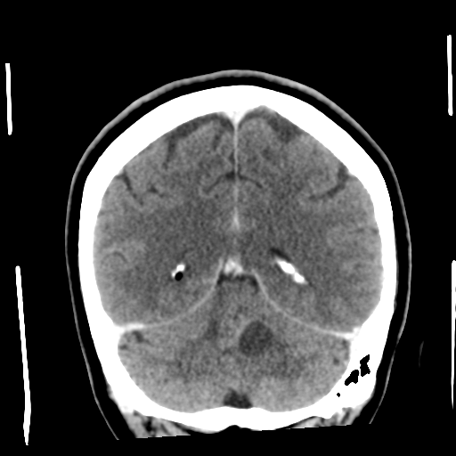 Cerebellar metastasis (cystic appearance) (Radiopaedia 41395-44258 D 44).png