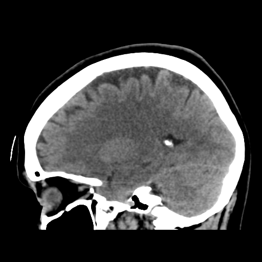 Cerebellar metastasis (cystic appearance) (Radiopaedia 41395-44258 E 37).png
