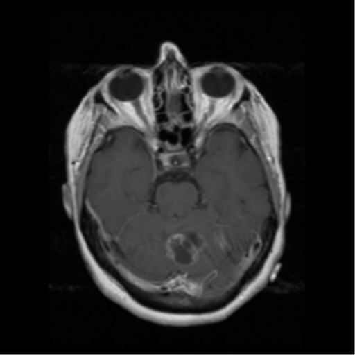 File:Cerebellar metastasis (cystic appearance) (Radiopaedia 41395-44262 Axial T1 C+ 7).png