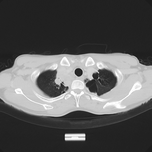 Cerebellar metastasis - adenocarcinoma lung (Radiopaedia 63184-71717 Axial lung window 12).png