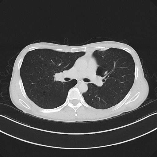 Cerebellar metastasis - adenocarcinoma lung (Radiopaedia 63184-71717 Axial lung window 31).png