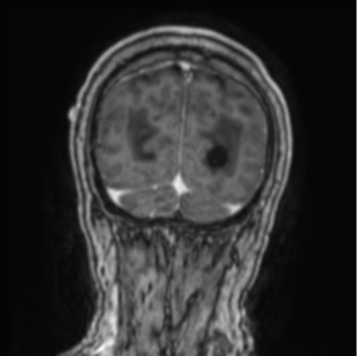 File:Cerebellar metastasis from lung adenocarcinoma (Radiopaedia 86690-102829 Coronal T1 C+ 17).png