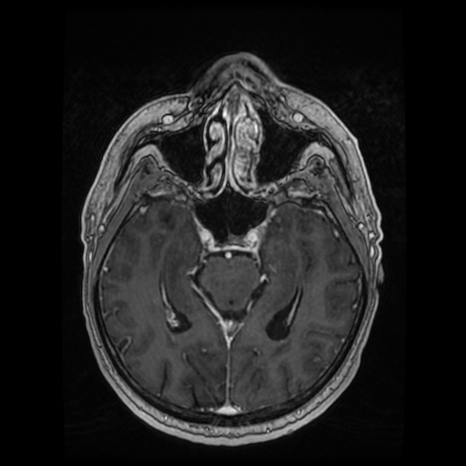 Cerebellar metastasis of pulmonary adenocarcinoma, cavernous venous malformation, and developmental venous anomaly (Radiopaedia 85827-101661 Axial T1 C+ 42).jpg