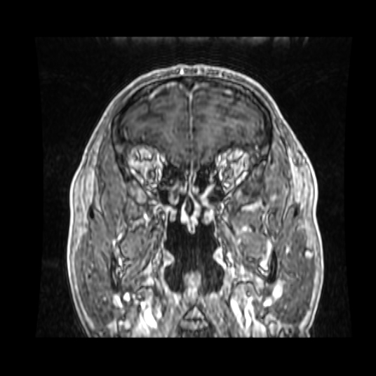 Cerebellar metastasis of pulmonary adenocarcinoma, cavernous venous malformation, and developmental venous anomaly (Radiopaedia 85827-101661 Coronal T1 C+ 75).jpg