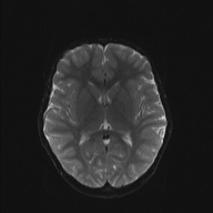 File:Cerebellar stroke (Radiopaedia 32202-33150 Axial DWI 13).png