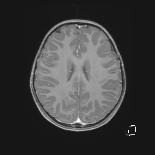 Cerebellar stroke (Radiopaedia 32202-33150 Axial T1 C+ 47).png