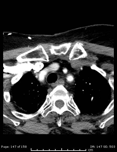 Cerebellar strokes due to intracranial giant cell arteritis (Radiopaedia 68799-78510 CT angiogram 147).jpg