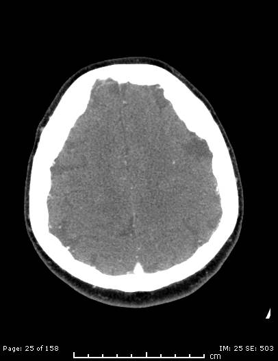 Cerebellar strokes due to intracranial giant cell arteritis (Radiopaedia 68799-78510 CT angiogram 25).jpg