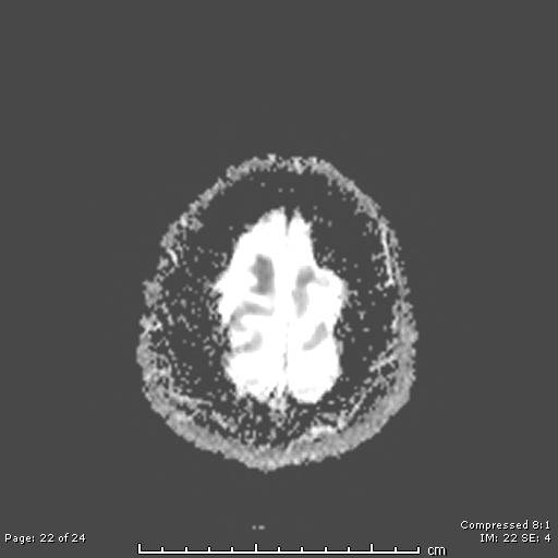 File:Cerebellar strokes due to intracranial giant cell arteritis (Radiopaedia 68799-81713 Axial ADC 22).jpg